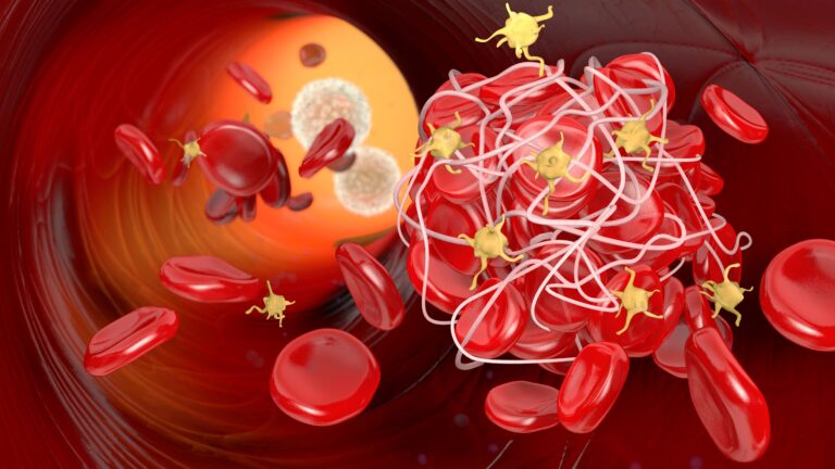 Medical illustration for The Story of a Genius Victimized by His Own Discovery: Trousseau Syndrome