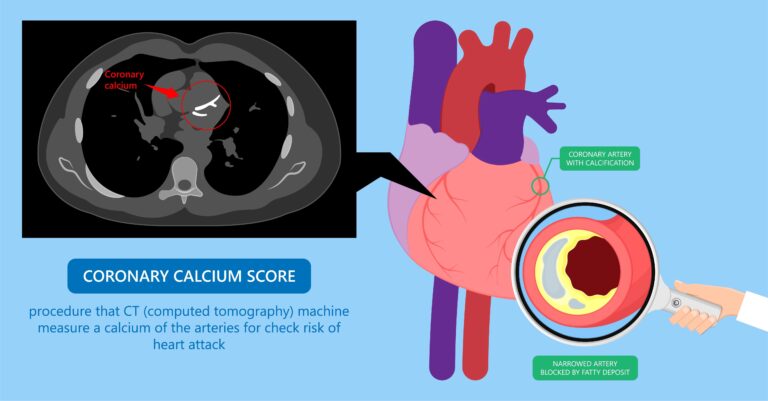 Medical illustration for The Clinical Labyrinth of Coronary Artery Calcium Accumulation in