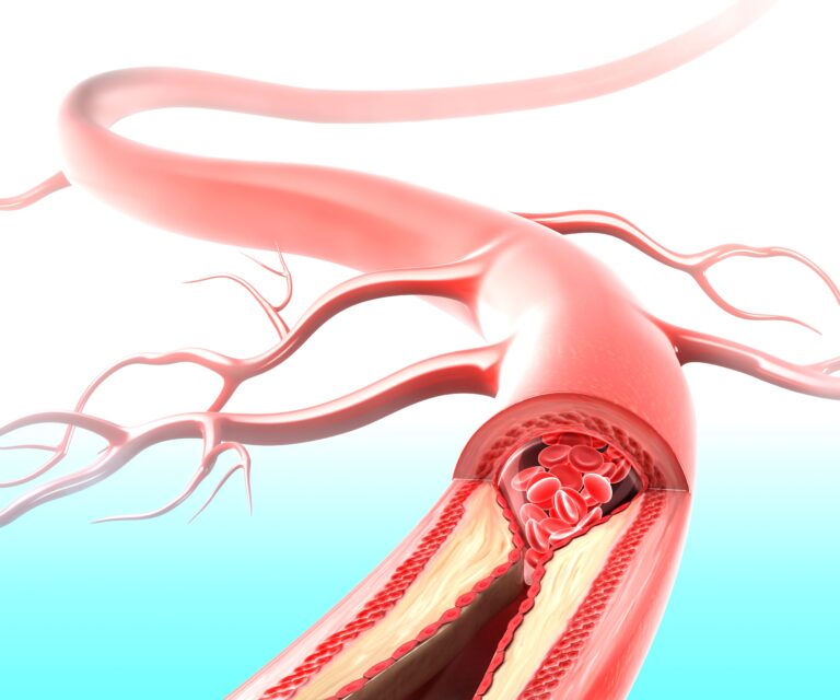 Medical illustration for Beyond LDL: Remnant Cholesterol and Vascular Inflammation