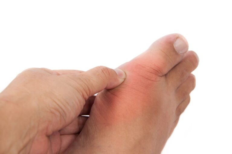 Medical illustration for Crystallized Agony: The Cellular Warfare Behind Gout and the Uric Acid